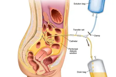 Peritoneal in katihar, best nephrologist in katihar, cost of Peritoneal dialysis in katihar, best hospital for dialysis in katihar, best doctor forperitoneal dialysis in katihar