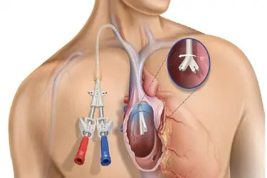 Permcath Procedure for Dialysis, Temporary Dialysis Catheterization, Emergency Dialysis in Purnia, Best Dialysis Centre in Purnia, Best Nephrologist for Permcath in Purnia