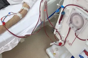 SLED Dialysis in Bihar, Emergency Dialysis, Dialysis in ICU, Best Dialysis Centre in Bihar, Cost of Emergency Dialysis in Bihar